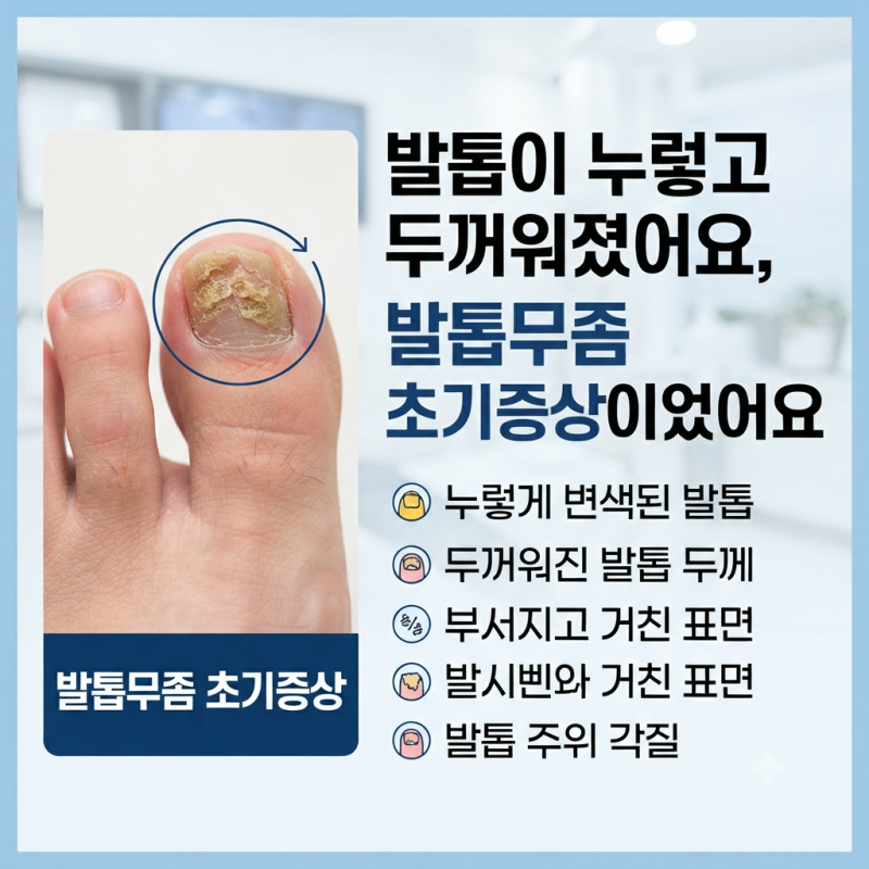 발톱이 누렇고 두꺼워졌어요, 발톱무좀 초기증상이었어요