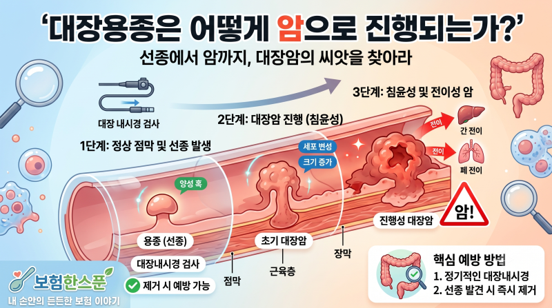대장용종은 어떻게 암으로 진행되는가?