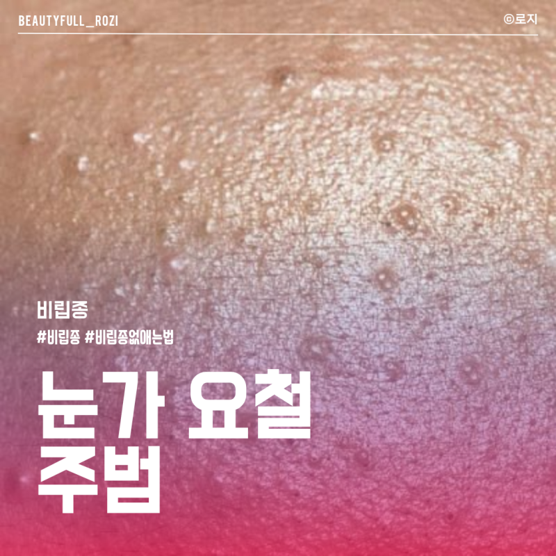 비립종 원인부터 없애는 법까지, 눈밑 비립종 집에서 짜면 안 되는 이유