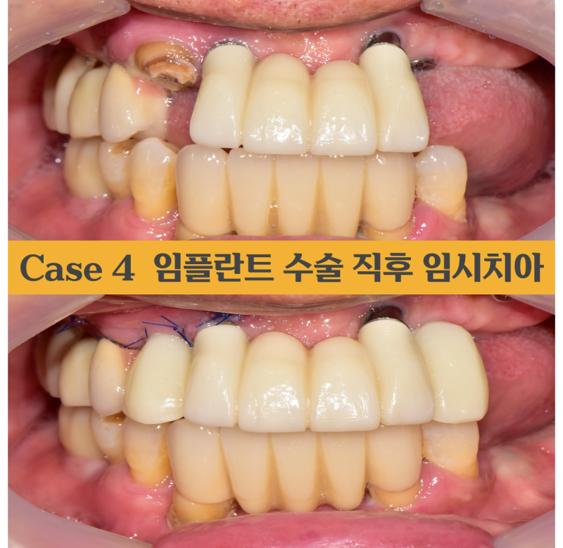 임플란트 case 4) 앞니가 부러졌어요. 임시치아 빨리 할 수 있나요?