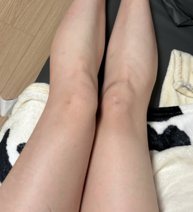 골육종 뼈에 생기는 희귀 질환의 초기 특징