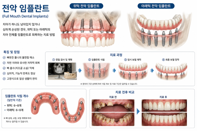풀아치 임플란트는 뭔가?