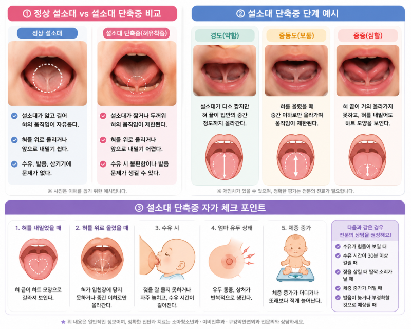 신생아 설소대 짧으면 꼭 시술해야 할까? 수유 영향부터 시기까지