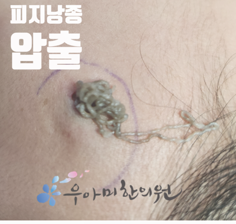 머리 피지낭종, 두피에서 만져지는 작은 혹은 무엇일까
