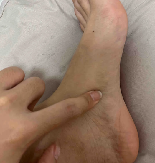 족저근막염 약 복용할 때 염증 완화 효과와 알아둘 점