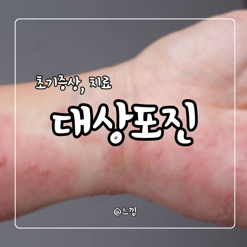 대상포진 증상 초기 원인 가려움 치료 얼굴 대상포진