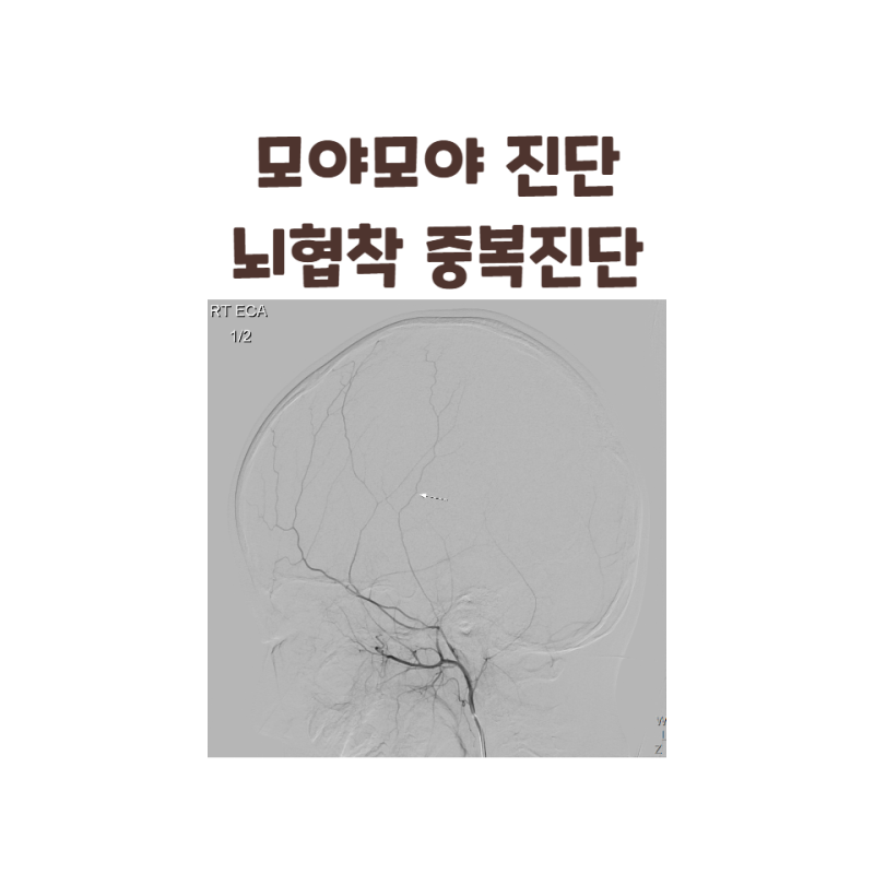 모야모야병과 뇌협착 중복코딩, 보험금 지급 거절 사유 모야모야병 보험금 분쟁의 함정