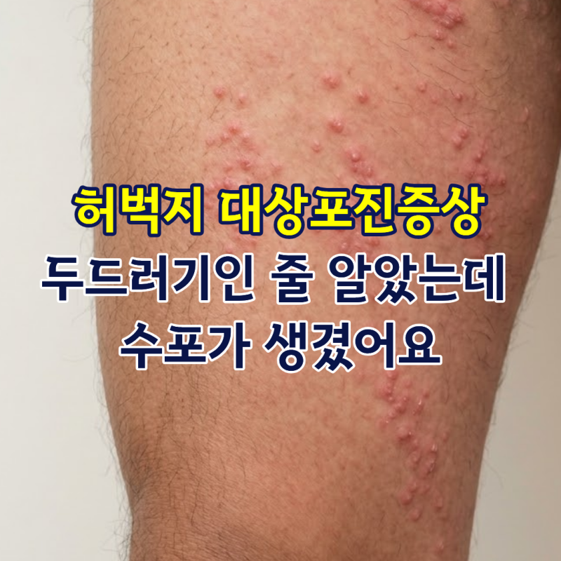 허벅지 대상포진증상, 두드러기인 줄 알았는데 수포가 생겼어요