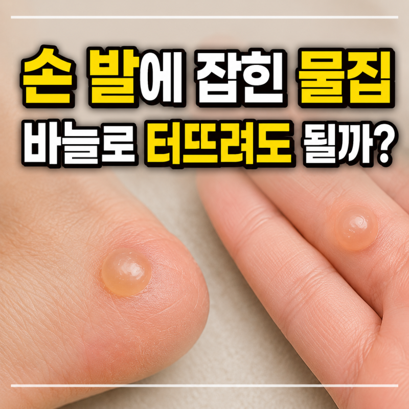 손 발에 물집 생겼을때 터뜨려도 될까 터졌을때 치료방법까지 정리