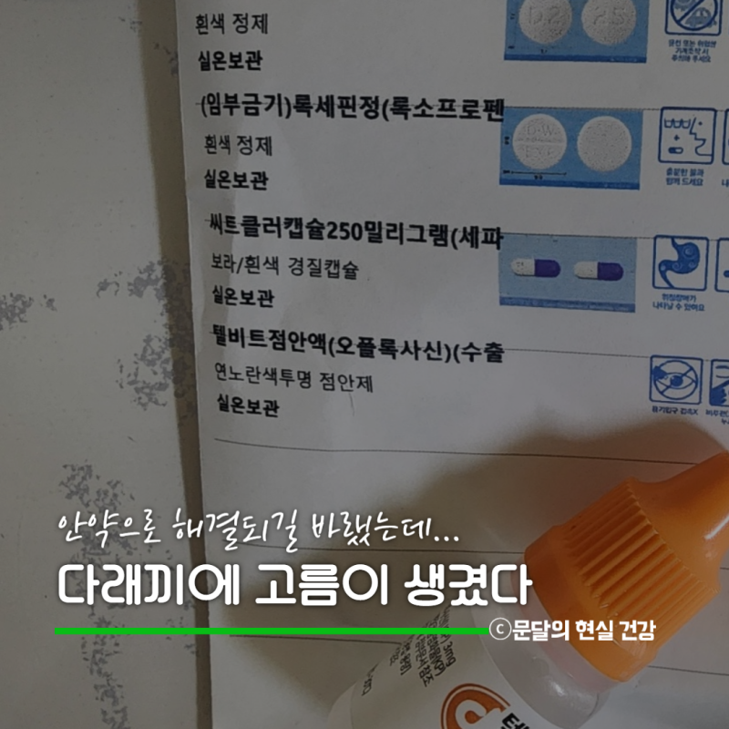 눈 속 다래끼 고름 생기기 전에 초기 치료 받으시길..