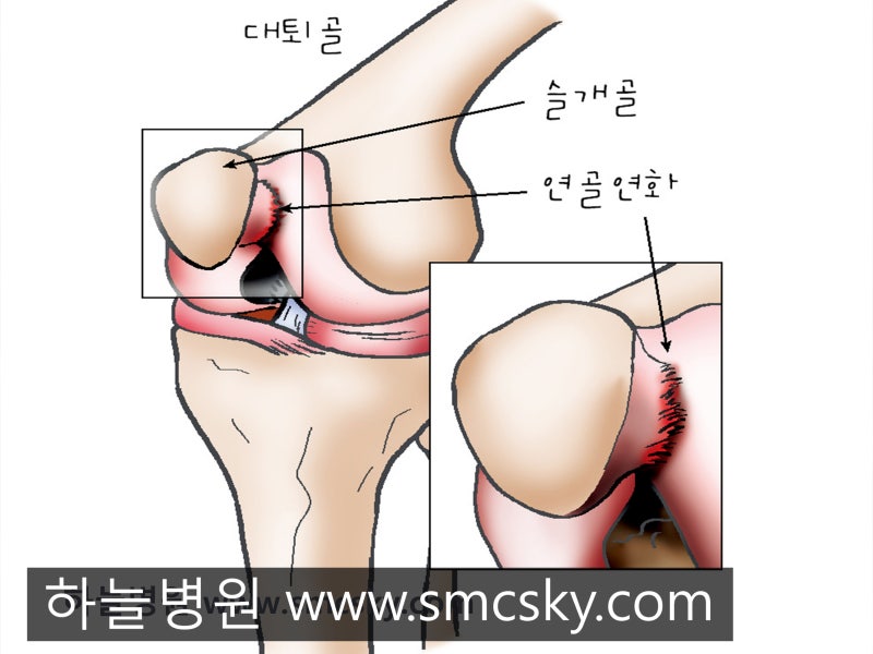 무릎통증 슬개골 연골연화증과 슬개건염 증상 및 치료, 운동할까?