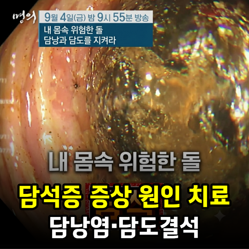 담석증 증상 원인 치료, 담낭염·담도결석