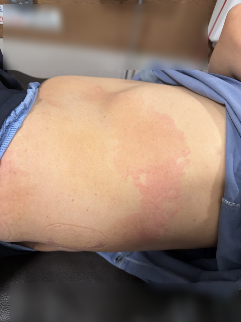 울산두드러기피부과, 병원약 먹어도 그때 뿐인 사람들이 놓친 1가지