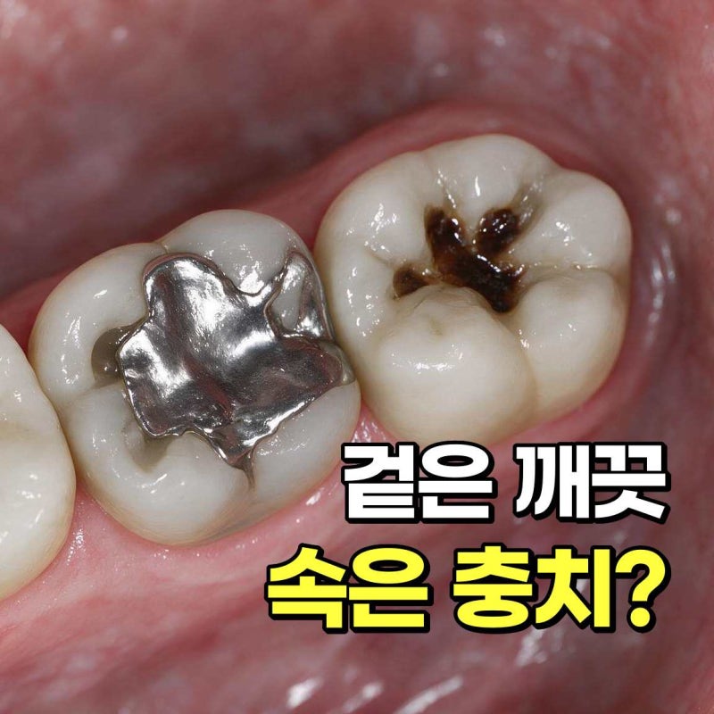 오래된 아말감 교체와 세라믹 인레이｜치료 과정과 장점, 관리 방법