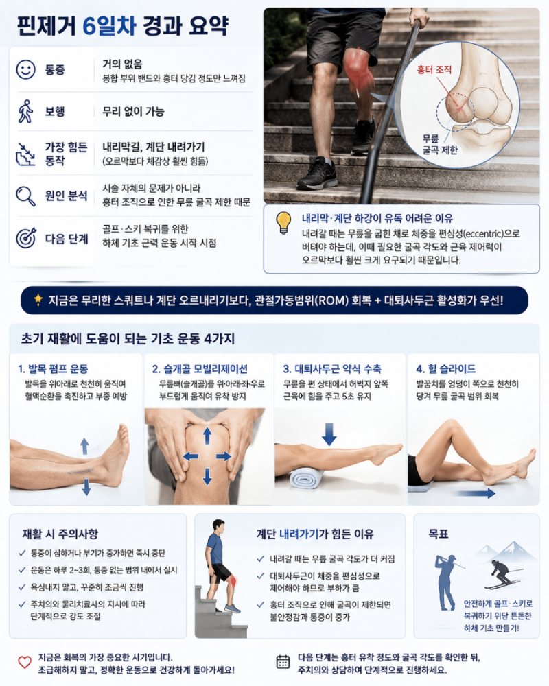[십자인대 재건술] 십자인대 핀제거 후 생활. 수술 6일차. 계단내리기가 가장 힘드네.