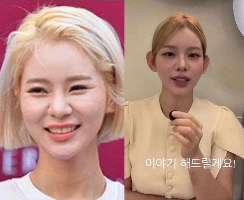 맹승지 인중 축소 600만원 성형 고백, "한 달간 진짜 못생겼었다" 붓기 솔직 후기