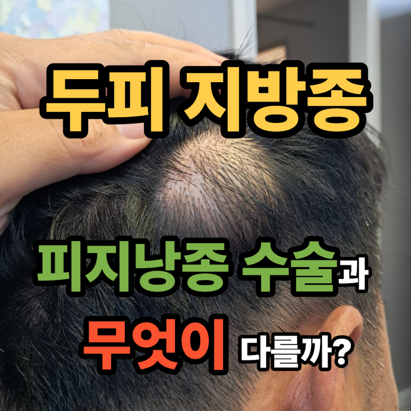 머리 두피 지방종, 피지낭종 수술과 무엇이 다를까?