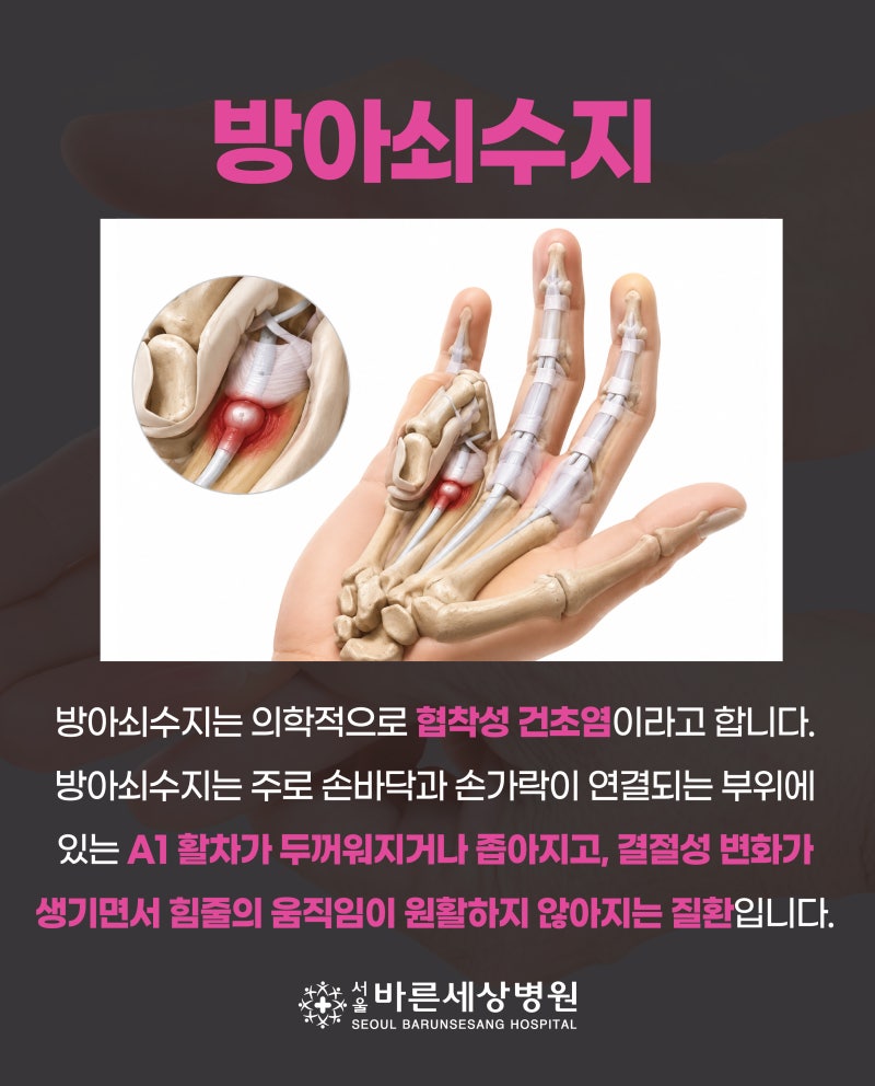 [질환] 손가락이 안 펴져요, 딸깍 소리 나는 방아쇠 수지 원인과 치료방법