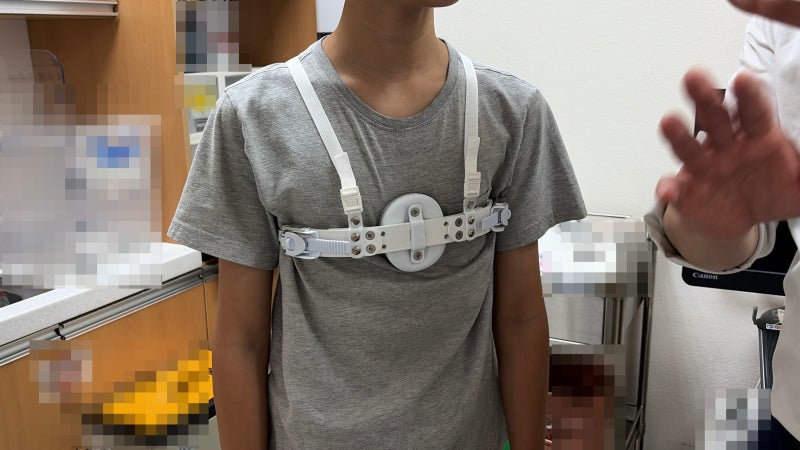 초등학생 새가슴 교정 두번째 진료 후기 교정기 받아온 날