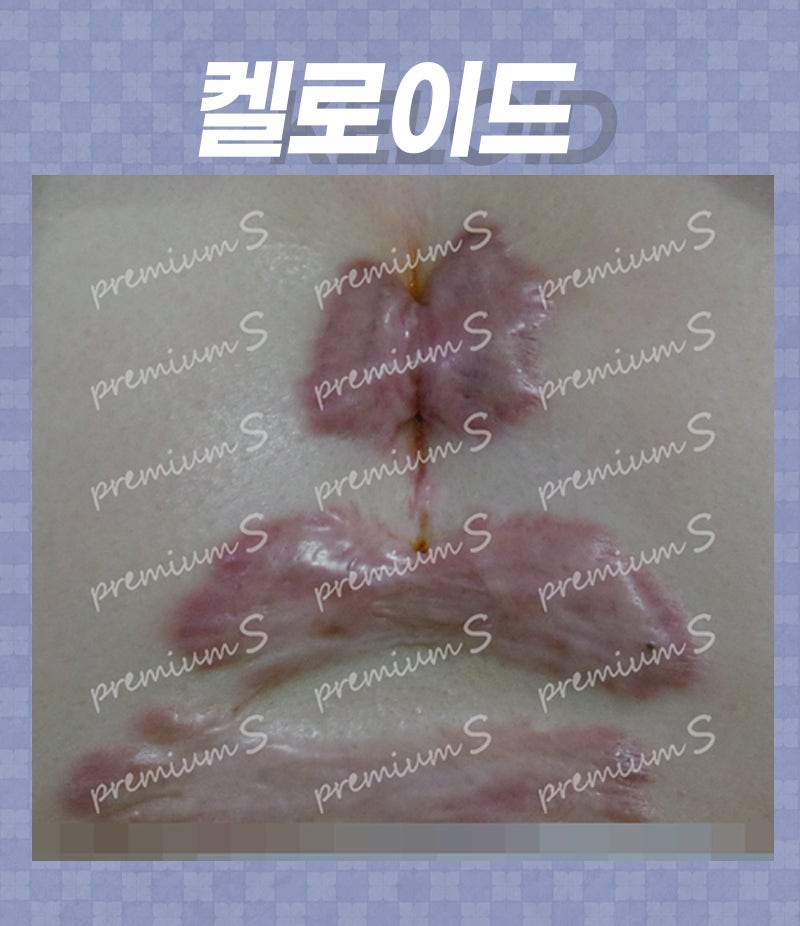 부산켈로이드흉터수술, 염증이 많은 피부이면 더 쉽게 생길까?