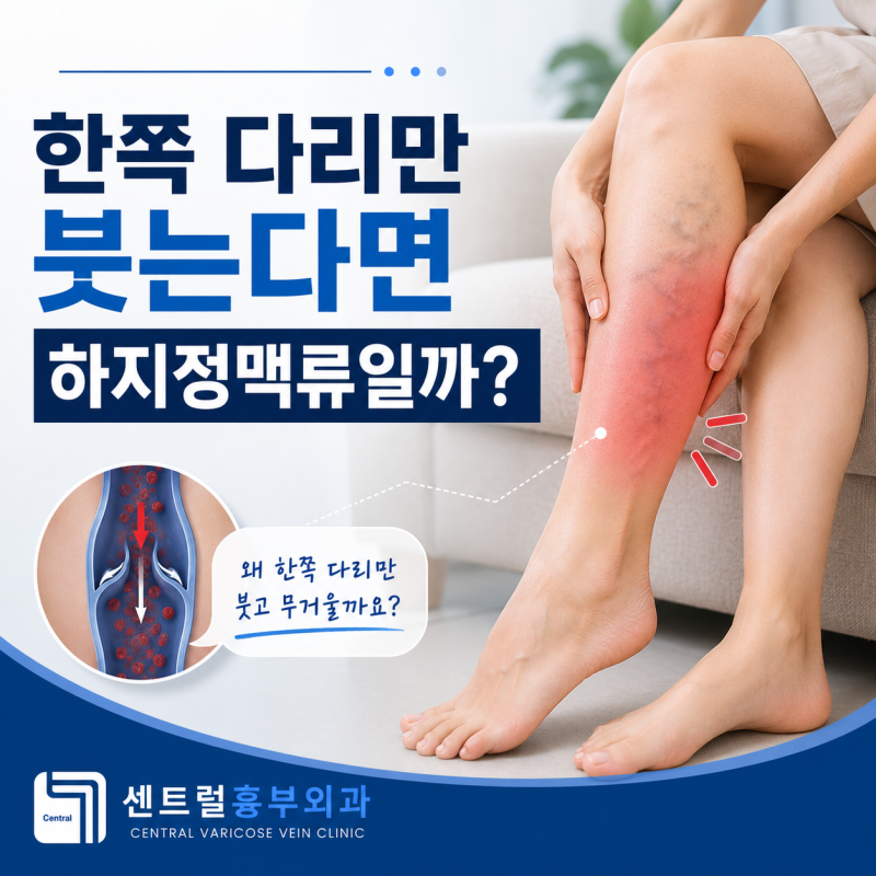 한쪽 다리만 붓는다면 하지정맥류 증상일까?