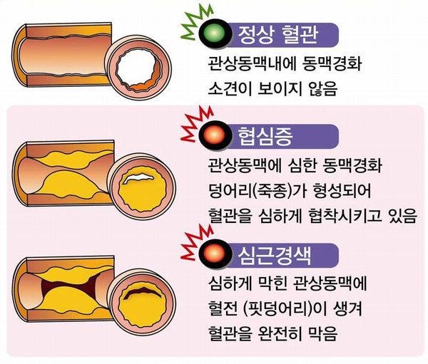 협심증 증상과 원인 치료방법
