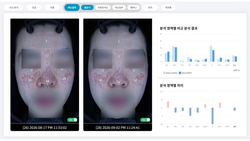 스킨수티컬즈, 아렌시아 비타민C vs 리쥬란 PDRN 모공 라인, 2주 차 결과 - 3편