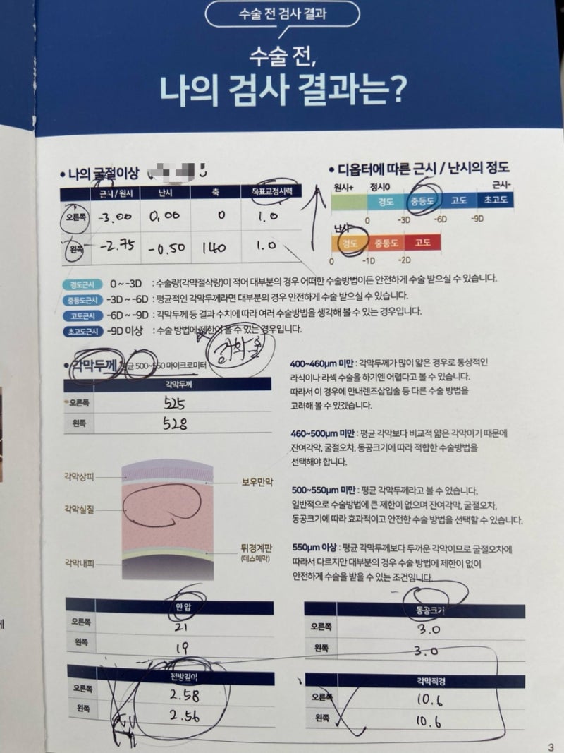 강남 ‘밝은 미소 안과’ 스마일 라식 후기 및 비용 (광고x, 내돈내산)