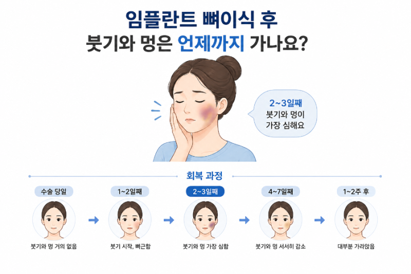 임플란트 수술 및 뼈이식 후 붓기와 멍은 언제까지 가나요?