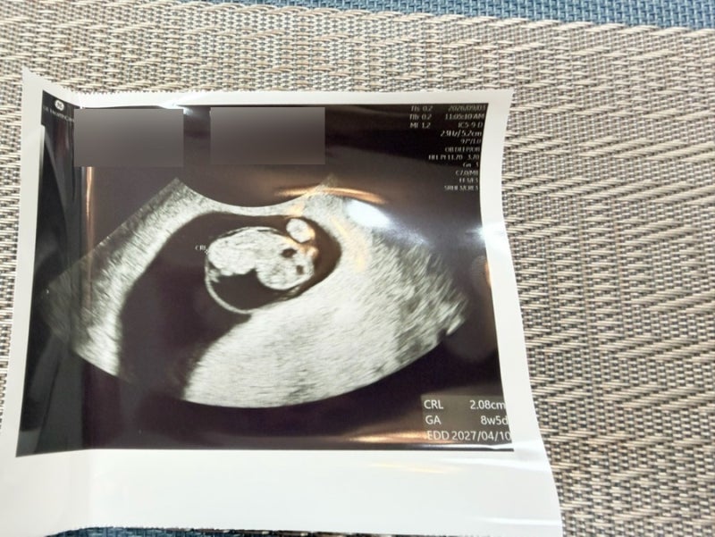 임신일기3_ 에뜨와 양띠양말 구매 8주차 젤리곰 초음파 피고임 다시 거의 사라짐 안심할 수 ....