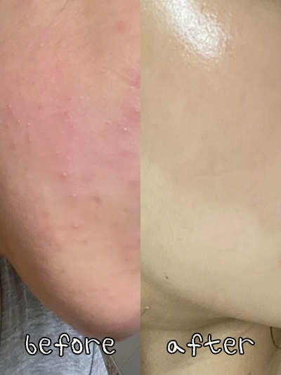 접촉성 피부염 가려움 얼굴 붉은기 빨리 가라앉히는법