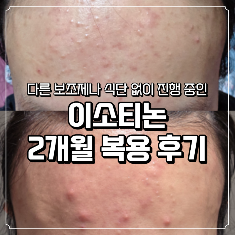 이소티논 2개월 복용 후기 주차별 여드름 증상 변화 공유