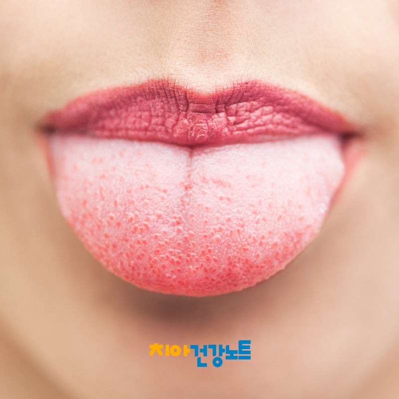 구강 칸디다증 병원 가야 할까? 원인 낫는법 : 혀가 하얘졌다면