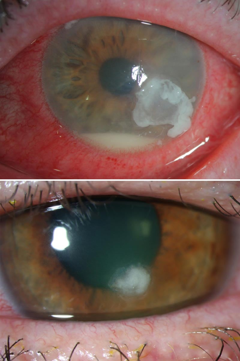 눈 앞의 0.5 mm가 무너질 때: 감염성 각막염 Infectious keratitis·각막궤양 Corneal ulcer 2,500년의 추적