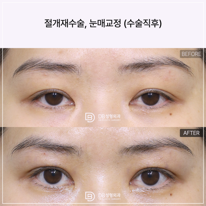 쌍꺼풀재수술비용, 소세지눈·짝눈 유형별 가격 차이 나는 진짜 이유