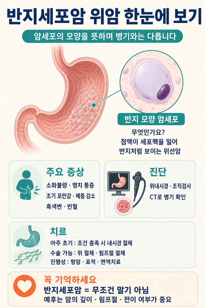 반지세포암 위암이란? 증상부터 진단·치료·예후까지
