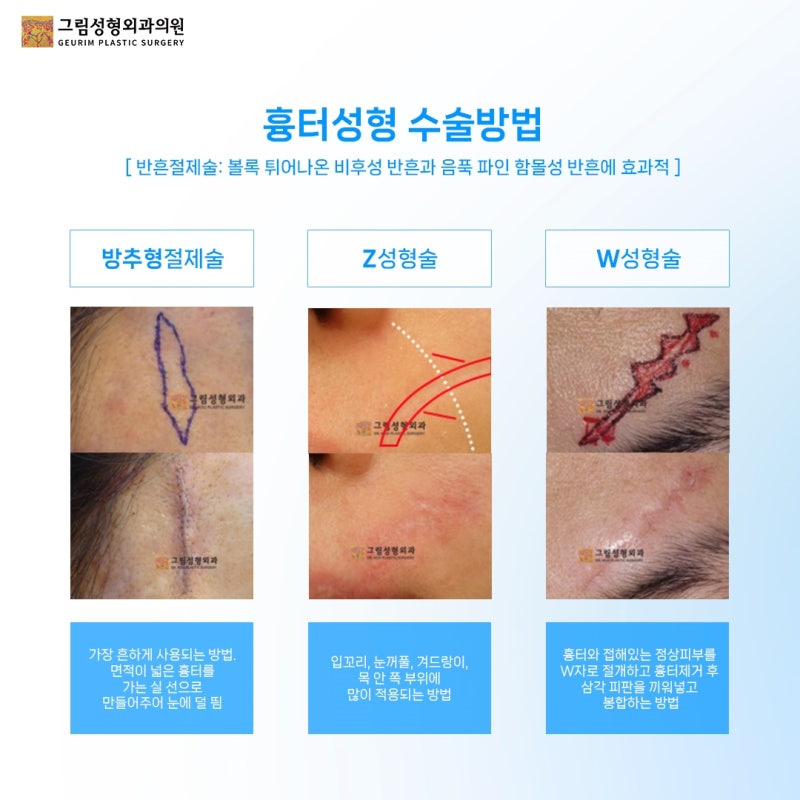 흉터 제거 비용 실비보험 적용 여부부터 확인해야 하는 이유