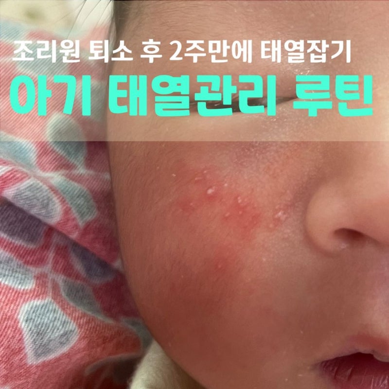 신생아 태열관리 성공! 조리원 퇴소 후 2주 만에 꿀피부 회복한 루틴 (에어컨 없는방, 쁘리마....