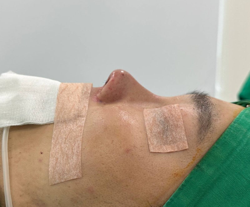 비염 기능코성형, CT에서 확인한 비중격만곡증과 하비갑개 비대