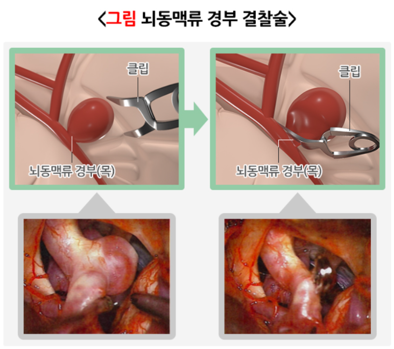 [시화병원 메디프렌즈 서포터즈 1기 활동] 뇌혈관에 ‘꽈리’가 있다고요? 뇌동맥류는 발견....