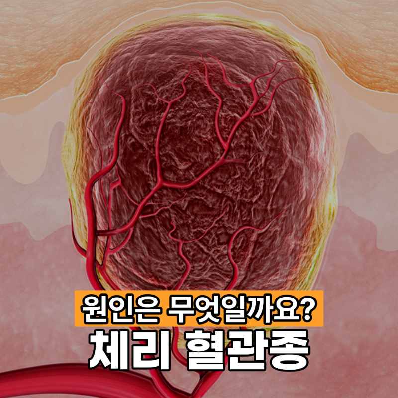체리 혈관종 원인은 어떤 것일까요?