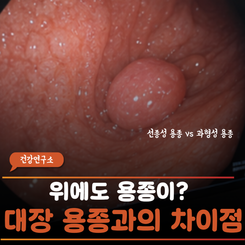 “이거 암으로 가는 전 단계인가요?”내시경대 위에서 마주한 위용종의 종류와 대처법