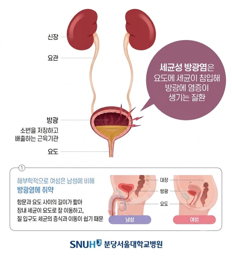 방광염이 신장까지 올라가면 신우신염이 될 수 있습니다.