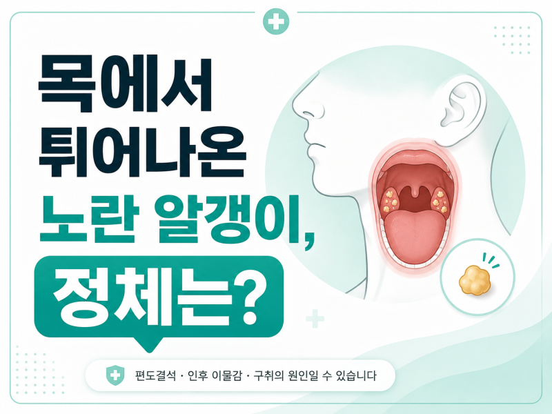 목에서 튀어나온 노란 알갱이, 편도결석 정체와 제거법
