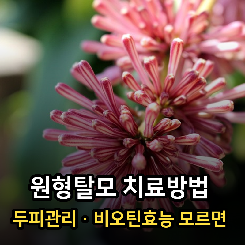 원형탈모 치료방법·두피관리·비오틴효능 모르면 머리카락 다 빠집니다, 직접 겪어보고 쓴 ....
