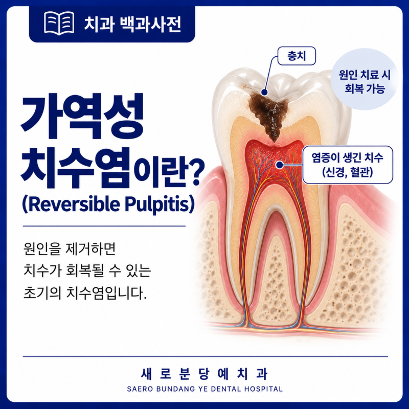 가역성 치수염(Reversible Pulpitis)이란?