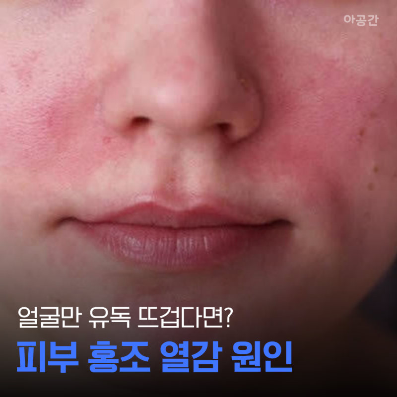 피부 홍조 열감, “얼굴만 유독 뜨겁다면” 체온 때문만은 아니다