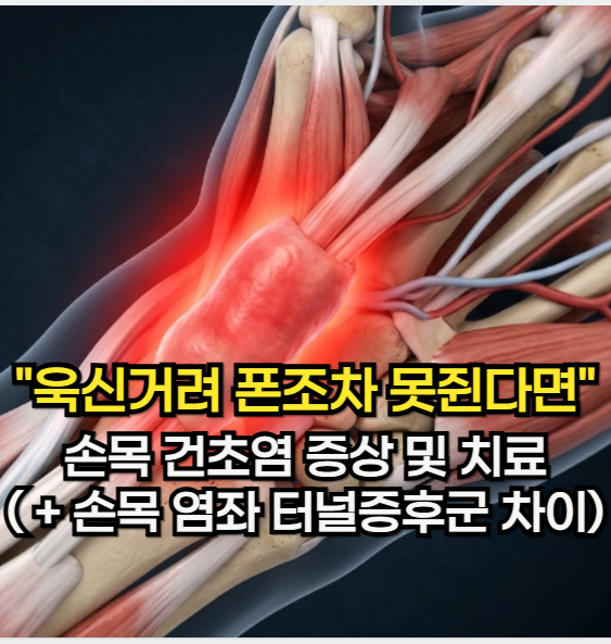 손목 건초염 증상 "엄지가 욱신거려 폰조차 못 쥔다면" 손목 건초염 치료 ( + 손목 염좌 터널 ....