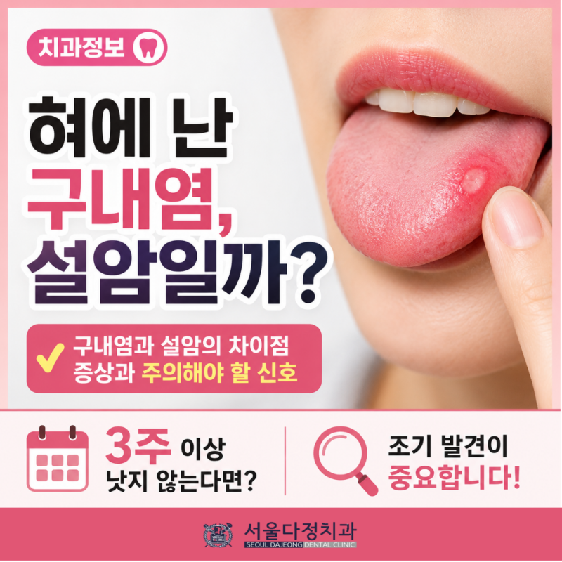 혀에 생긴 구내염, 설암일까? 구강설암 증상과 구내염 차이 알아보기