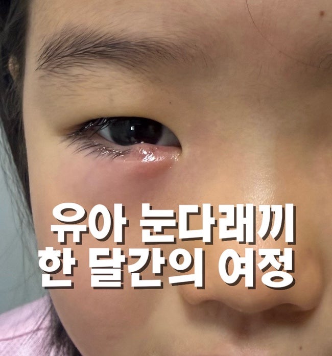 7세 유아 눈다래끼(콩다래끼)배농 후기_그냥 째냐 수면마취냐 한 달 여정 끝에 드디어 해결